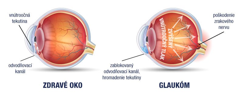 magas vérnyomású glaukóma